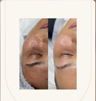 Limpieza facial